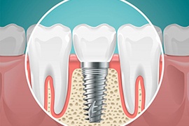 Illustration of osseointegration