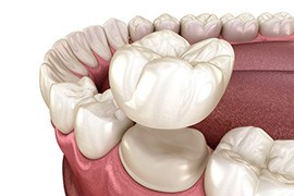 Illustration of dental crown being placed on prepared tooth
