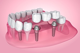 a graphic illustration showing a single tooth dental 