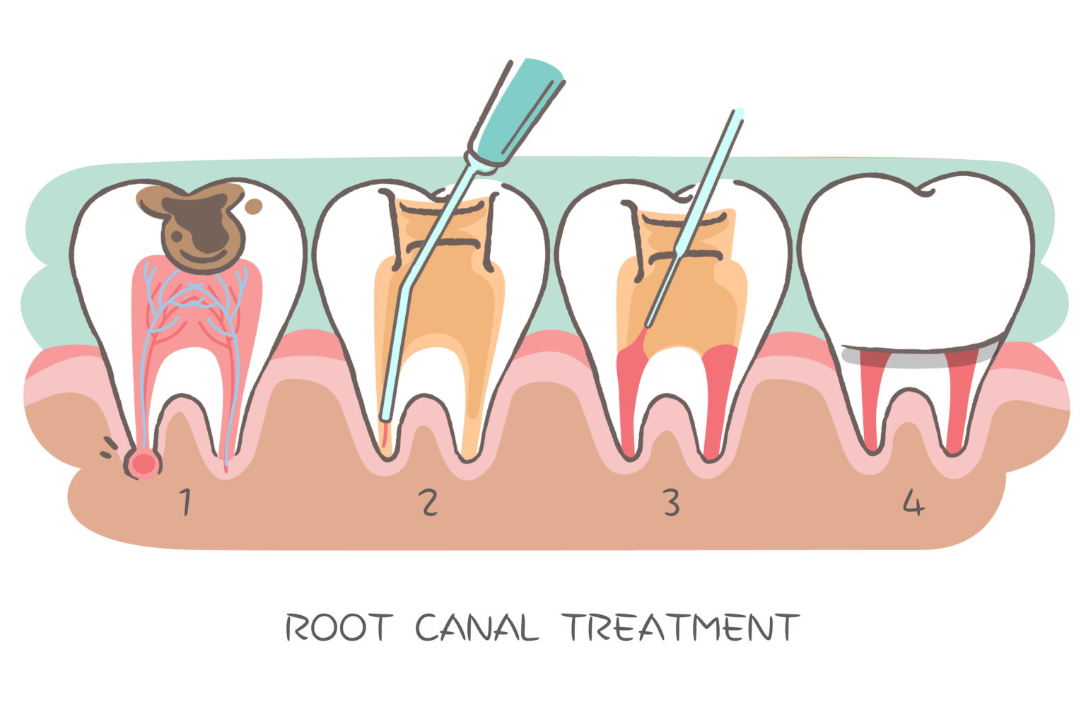 sifting-through-the-facts-and-fiction-of-root-canal-treatment-john